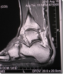 My Torn Achilles (Tear at the arrow)